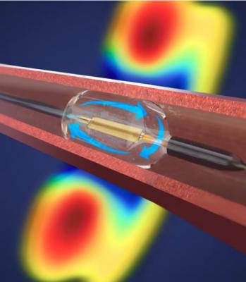The Record Paradise RDN catheter uses a balloon catheter filled with water to cool the vessel wall as ultrasound-based ablation energy is delivered. It delivers a ring of ablative energy to a depth of 1-6 mm. Kirtane said it requires 2-3 sonications lasting 7 seconds each in each of the main renal arteries. #ACC21 #ACC2021 #RDN