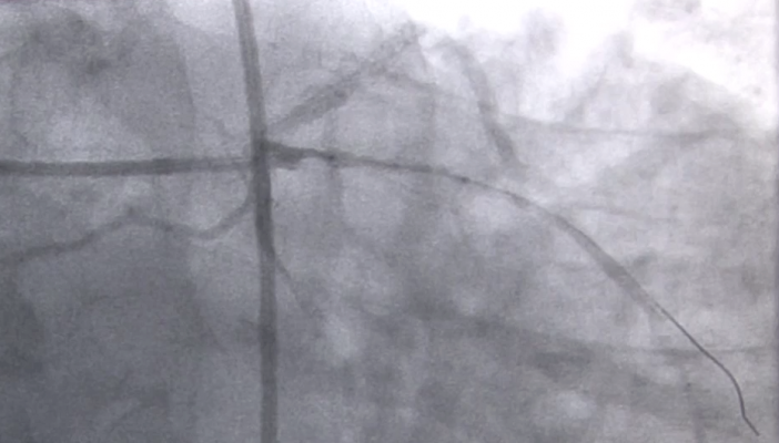 Stemi lesion as seen on angiography