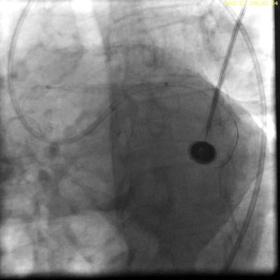 View of a Penumbra atherectomy system being used on a STEMI patient that had a 9 minute door-to-balloon time.