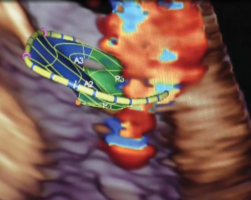A mitral regurgitation assessment using Siemen’s eSie Flow valve analysis software. From a 3-D echo dataset, the system can automate all the measurements, including PISA regurgitant volumes. Cardiac ultrasound, or echocardiography assessment of the mitral valve on 3D echo.
