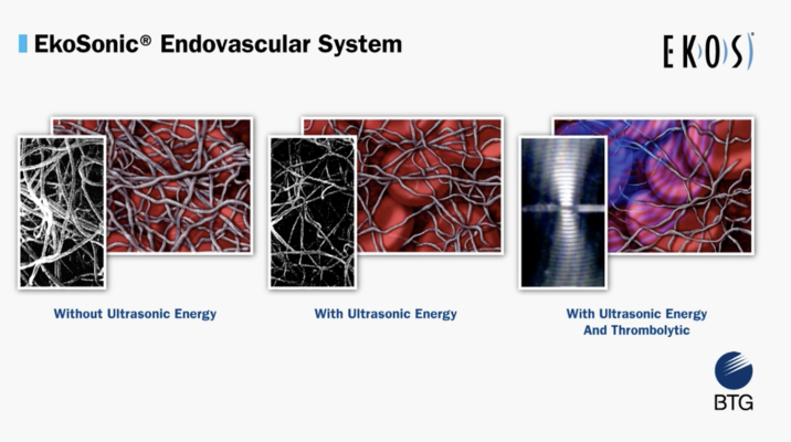  Primary tabs View(active tab) Edit Delete Revisions Entityqueue Devel Open configuration options Open configuration options Videos | Venous Therapies | June 27, 2017 VIDEO: How the Ekos Thrombolytic Technology Works to Dissolve Clots Open Related Chest Pain Imaging Content: configuration options Venous Thrombolytic System Demonstration  Play  Mute Remaining Time -3:23  Picture-in-Picture  Fullscreen This video, provided by Ekos, demonstrates the EkoSonic endovascular System thrombolytic system to treat dee