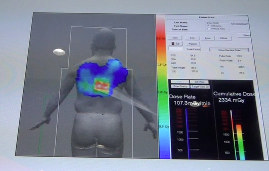 Toshiba is developing a radiation dose alert to show interventionalists how much dose they have delivered to their patient from X-ray angiography.