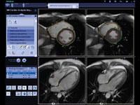 Siemens, syngo.MR Cardiac 4-D, MRI software
