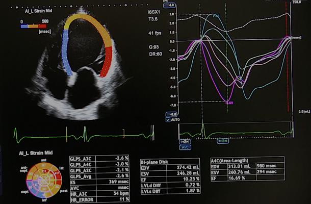 An example of strain imaging cardiac echocardiography software offered on Canon's cardiac ultrasound systems. It is highly automated to speed workflow. It color codes areas of different strain values, graphs these in a visual plot and pulls quantification measurements. Photo by Dave Fornell.