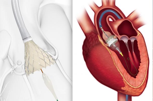 The most popular cardiac technology news in August 2019 was the FDA clearance for a new indication for both the Edwards Sapien 3 and Medtronic CoreValve transcatheter aortic valve replacement (TAVR) devices for low-risk patients. This puts the technology on equal footing with the previous standard-of-care of open heart surgery, representing a paradigm shift in cardiology. 