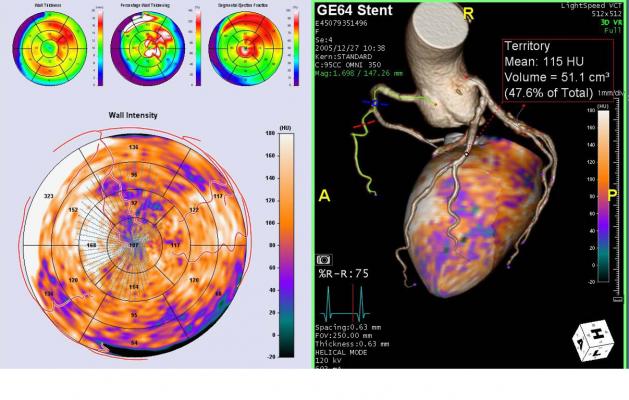TeraRecon's Lesion-Specific Analysis software can show areas of ischemia in the myocardium with a coronary vessel overlay as both a 3-D reconstruction of the heart or on bulls eye views.