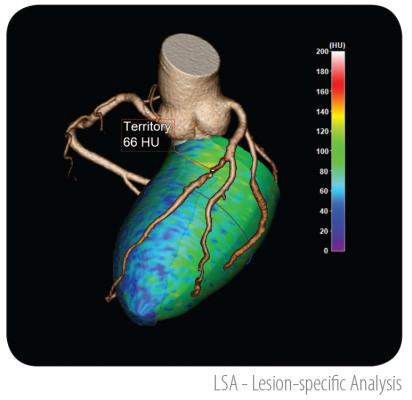 TeraRecon's Lesion-Specific Analysis software can show areas of ischemia in the myocardium with a coronary vessel overlay to quickly assess the likely culprit artery and vessel segment. TeraRecon Lesion-Specific Analysis