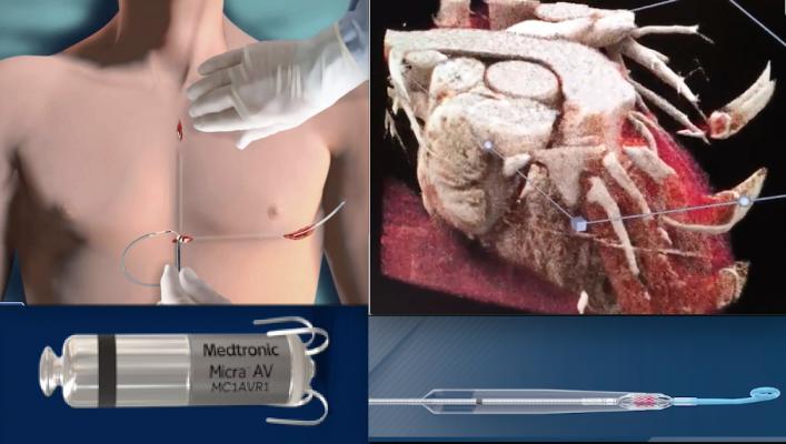 Demonstrations videos of new technologoies are among the most popular video content on the DAIC website each year. Included this year are videos showing how it install a subcutaneous ICD, CT photo-realistic rendering, How to implants the Micra leadless pacemaker and many others.