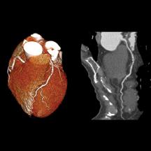 CT Coronary Calcium Scoring Predicts Long-term Cardiac ...