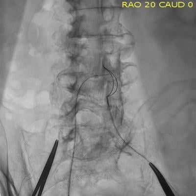 A transcaval access TAVR procedure, showing a guide wire in the vena cava and a snare located in the aorta to pull the guide wire through.