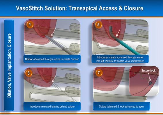 TAVR, EVAR Vascular Closure Device May Eliminate Need for Surgical Cut-Down