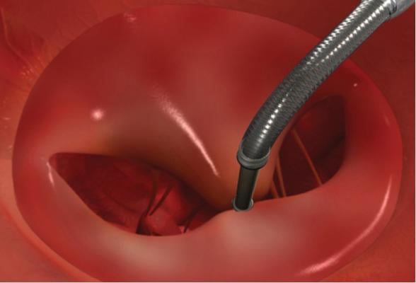 The Abbott Mitraclip device for transcatheter treatment of mitral valve regurgitation.