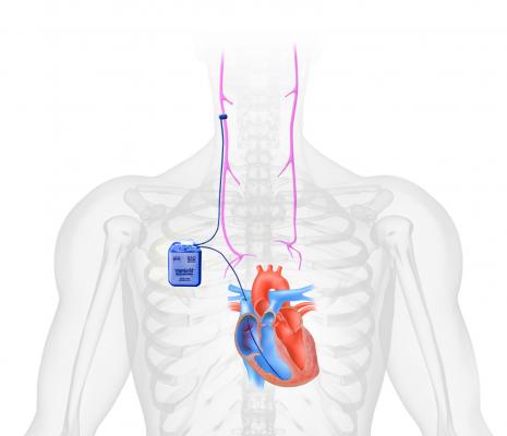 CardioFit vagus nerve stimulator 