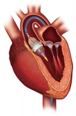 Edwards Sapien 3 cleared by FDA to use for valve in valve mitral procedures. #DAIC
