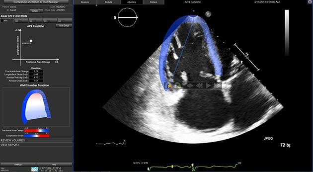 Epsilon's EchoInsight software helps analyze cardiac function by evaluating wall motion strain.  epsilon, echoInsight, cardio-oncology