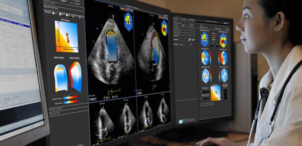 Epsilon's EchoInsight software to help evaluate cardiotoxcity due to chemotherapy or radiation therapy. epsilon, echoInsight, cardio-oncology