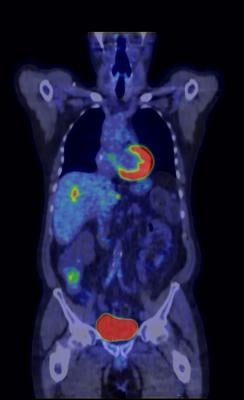 GE Healthcare Q.Clear Technology PET/CT Systems Nuclear Imaging