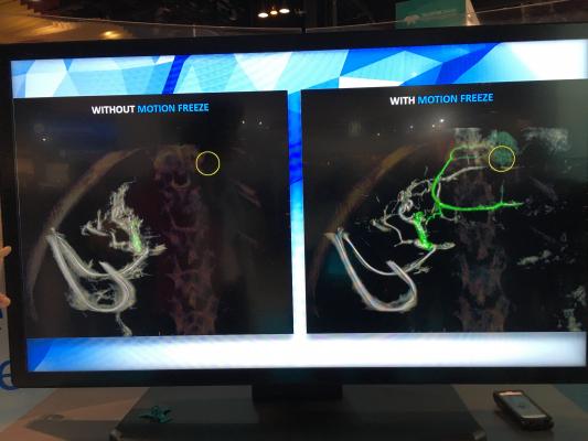 GE Healthcare showed a new Assist technology for its interventional guided therapy (IGS) angiography systems' rotational angiography.  RSNA 2017, #RSNA2017, #RSNA17 