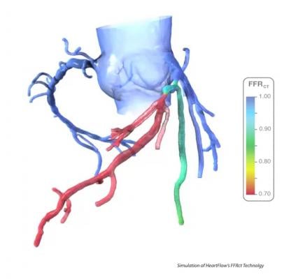 FFR-CT, heartflow
