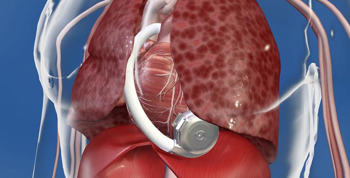 Heartware HVAD recall for its ventricular assist device from Medtronic