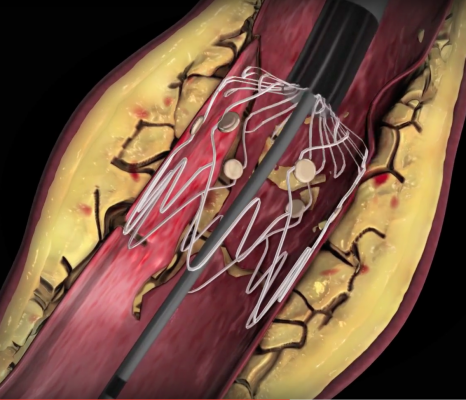 Intact Vascular Inc. developed the Tack Endovascular System to repair artery dissections caused by balloon angioplasty. Rather than using a full-sized stent, this system "tacks" the vessel wall with a very short stent of only a few millimeters to avoid encasing the vessel with metal, which can lead to high restenosis rates.  