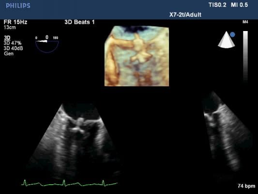 Philips' live 3-D TEE view of a mitral valve balloon valvuloplasty. Transesophageal echo