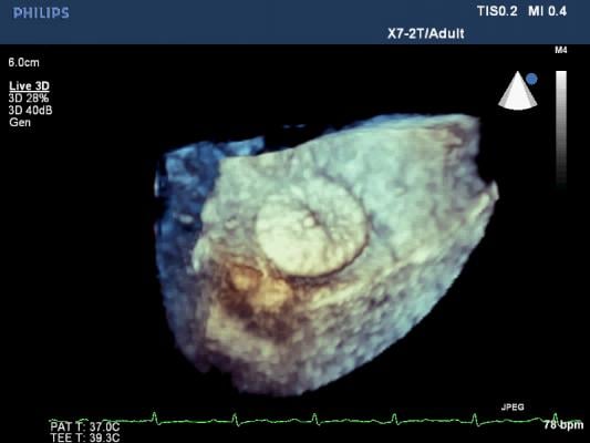 Philips' live 3-D TEE view of a mitral valve balloon valvuloplasty. Transesophageal echo (TEE)