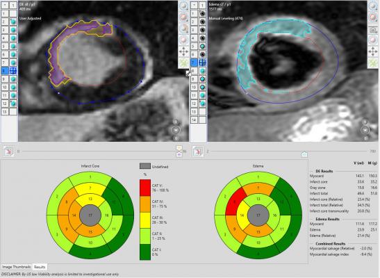 Pie Medical's cardiac MRI perfusion functional imaging CAAS MRV software for quantification.