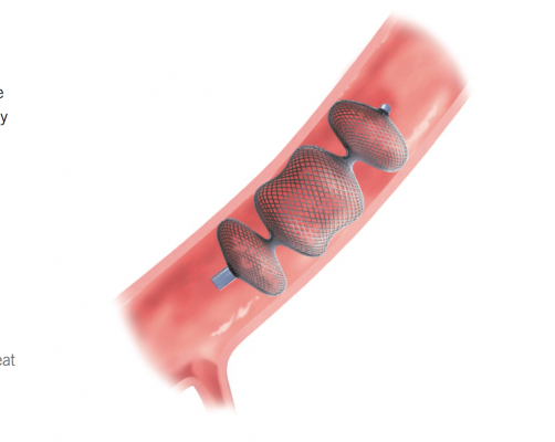 The Amplatzer Vascular Plug II illustrated in its intended use as a vacular occluder device.