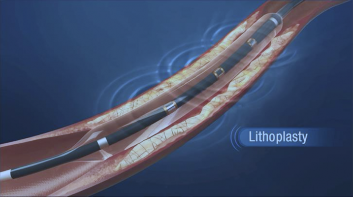Shockwave Medical’s Lithoplasty balloon catheters that use lithotripsy pulsatile mechanical energy bursts to shatter the calcium, rather than radial force of the balloon. 