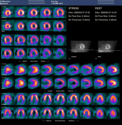 Ultraspect dose lowering software for nuclear imaging, SPECT imaging, reconstructions.