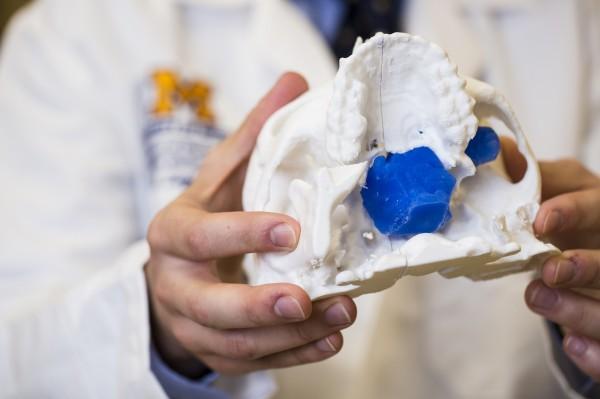 A 3-D printed skull showing the infiltration of brain tumor through the bone. This model was used for planning a complex surgical procedure to remove the tumor.