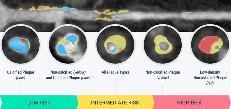 Cleerly, coronary artery disease, 