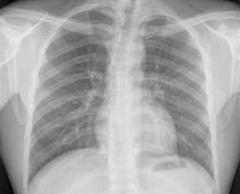 Figure 1. Normal chest X-ray