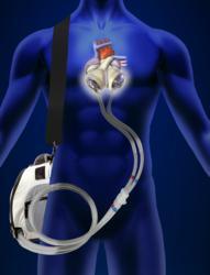 Fda Approves Freedom Portable Driver Powering Syncardia Total Artificial Heart Daic