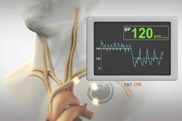 BackBeat CNT is the flagship therapy of Orchestra BioMed Inc. It is a bioelectronic treatment that immediately, substantially and chronically lowers blood pressure (BP) while simultaneously modulating the autonomic nervous system (ANS). 