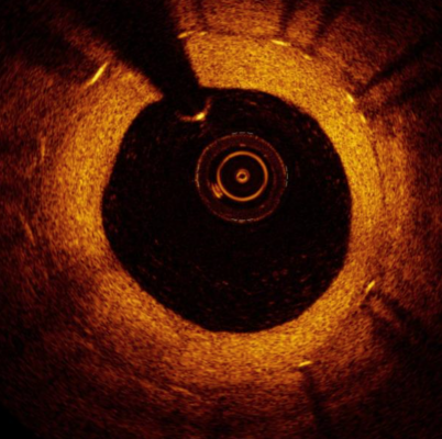 An OCT intracoronary image showing instent restenosis. The white spots in the vessel wall casting shadows are the stent struts. OCT image data might be used in the future to assess FFR to determine the severity of lesions and determine if they need to be stented.