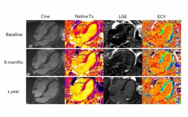 An advanced form of cardiac MRI, developed by academics at UCL in collaboration with the Royal Free Hospital, has for the first-time enabled clinicians to measure the effectiveness of chemotherapy in patients with the life-limiting condition ‘stiff heart syndrome’. 