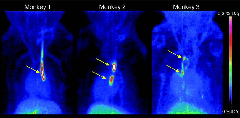 Novel PET Tracer Detects Small Blood Clots