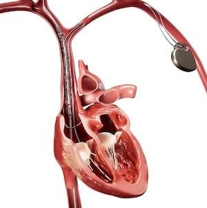 occlusion, electrophysiology