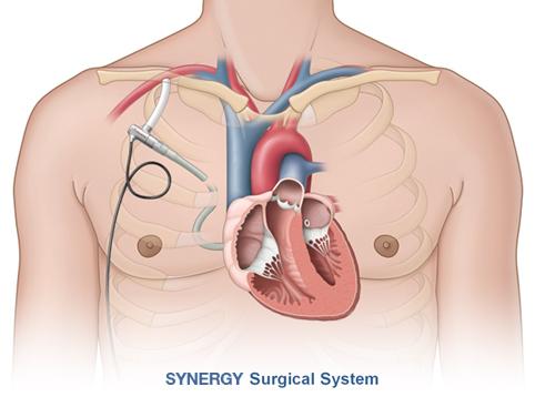 Synergy IC Circulatory Support System Circulite CE mark Trial