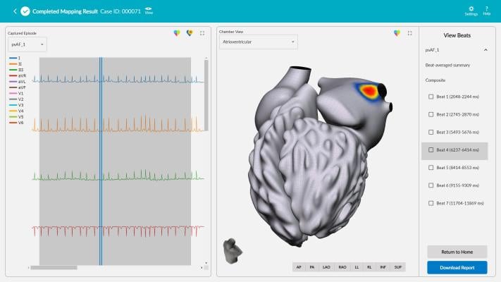 Vektor Medical has announced positive results from its “Vektor vMap Clinical Validation Study” evaluating the accuracy of cardiac mapping with vMap.