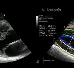 A new algorithmic module from OEM ultrasound AI software vendor RSIP Vision provides automated expert-level assessment of heart function from parasternal long axis view for point of care medical teams. Echocardiography artificial intelligence