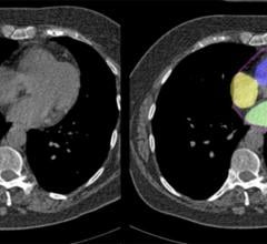 Using two primary markers‑— coronary calcium and heart chamber size — A routine chest scan without contrast shows promise for disease detection