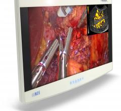 Radiance Ultra, NDS Surgical Imaging, flat panel displays, hybrid OR