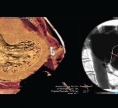 Pie Medical Imaging, 3mensio Structural Heart, mitral, septal crossing, workflow