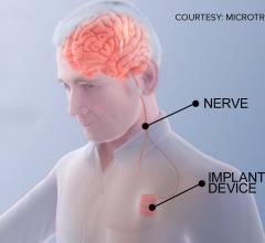 The Vivistim device is similar to a pacemaker, which uses leads to electrically stimulate the brain. A new clinical trial at The Ohio State University Wexner Medical Center is examining use of this device for stroke rehabilitation. 