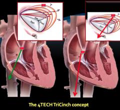 First TriCinch Coil Tricuspid Repair Systems Implanted in U.S.