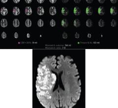 54-year-old patient with COVID-19 who underwent full angiographic reperfusion (extended thrombolysis in cerebral ischemia score = 3) after acute ischemic stroke. Top: Automated readout summary of CT perfusion data at presentation shows large mismatch volume (54 mL). Bottom: Follow-up MR image shows progression in infarction growth, with final infarction volume of approximately 72 cm3 (600% increase from CT perfusion imaging estimate of 9 mL shown in A). 