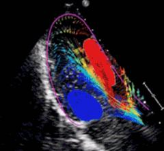 AMID's high definition blood flow tracking software for echocardiography.